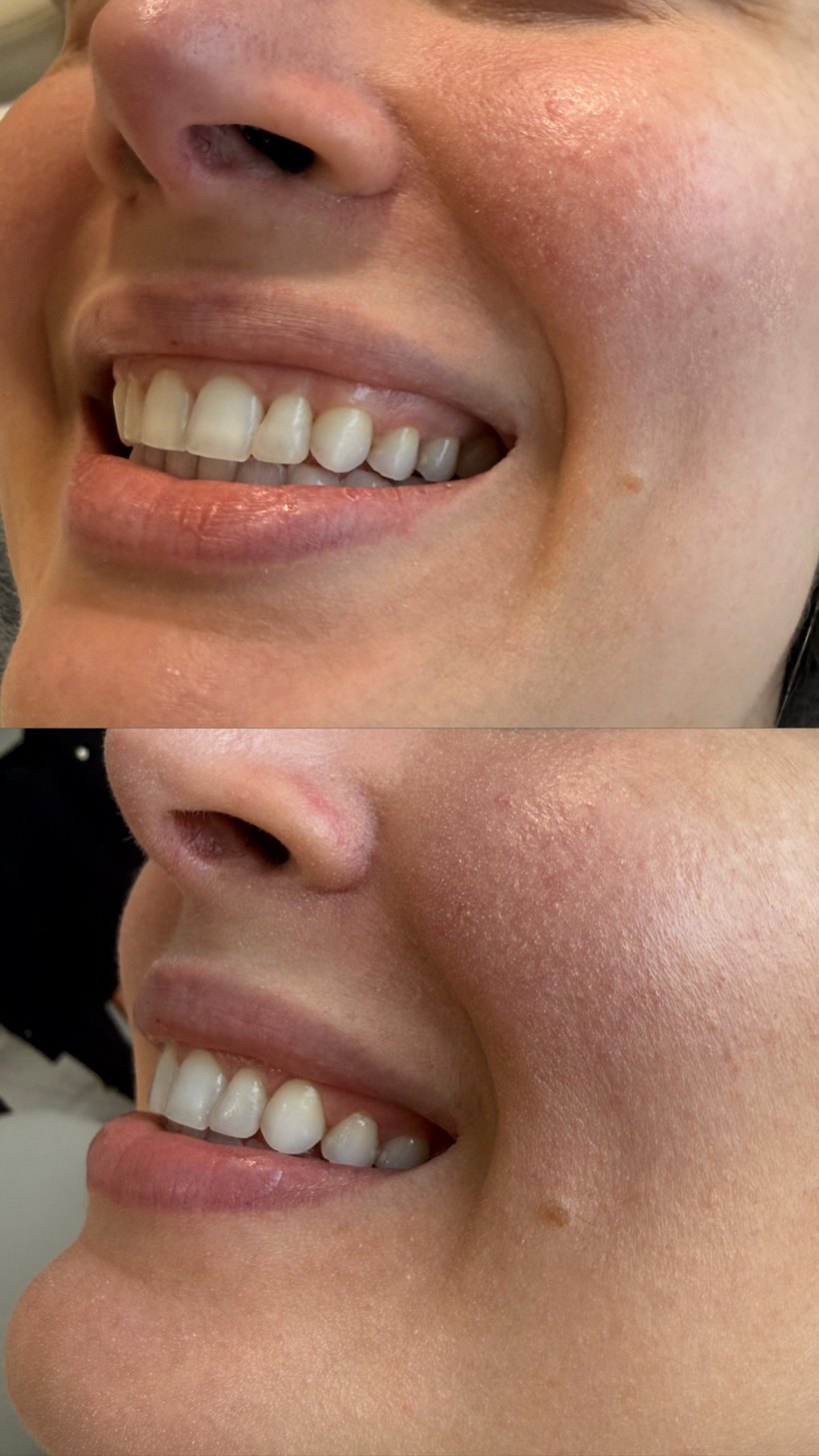 Antes e depois — harmonia do sorriso