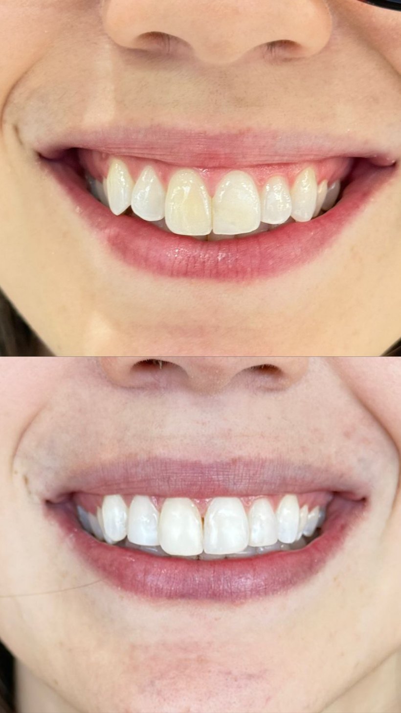 Antes e depois — sorriso